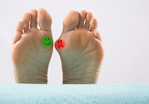 Umgang mit Hallux-valgus-Symptomen: 3 einfache Tipps, um Komfort bei Bewegung zu bewahren